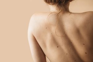 prevenzione cura nei melanoma