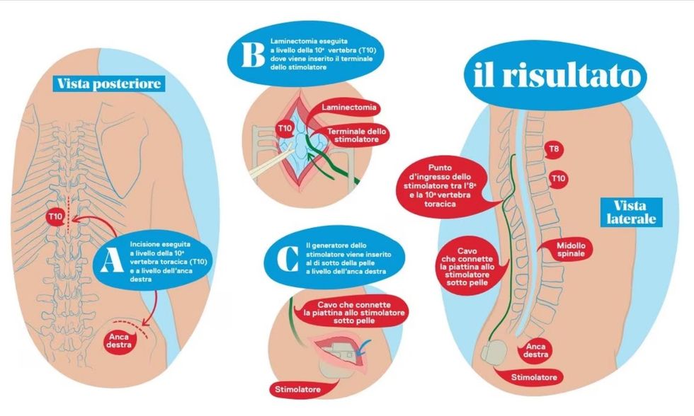 Neurostimolatore 